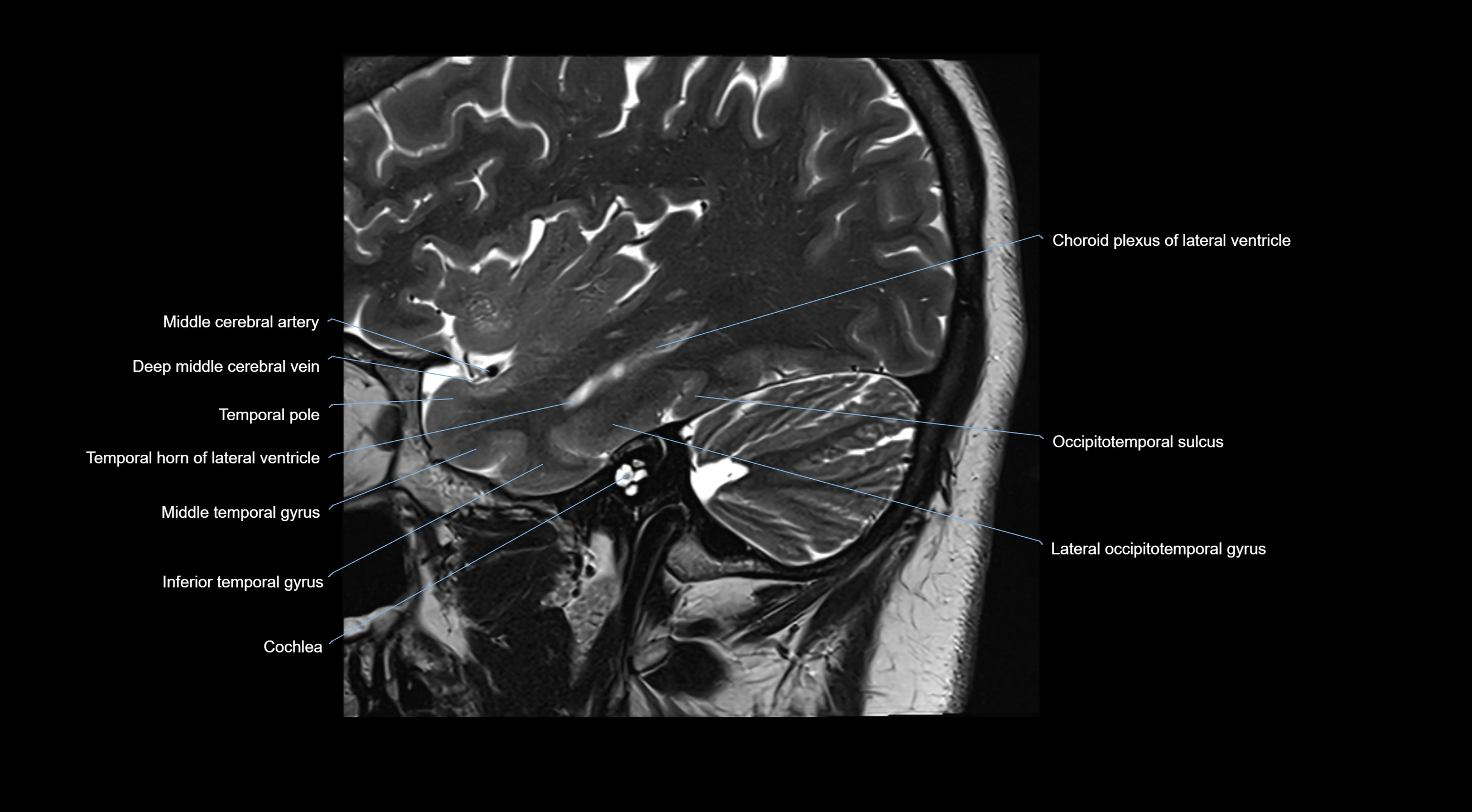 MRI brainstem & basal ganglia anatomy labelled  3T MRI images -img-10001-00009.webp